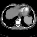 Biliary necrosis - liver transplant (Radiopaedia 21876-21845 A 6).jpg