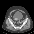 Bladder papillary urothelial carcinoma (Radiopaedia 48119-52951 Axial 48).png