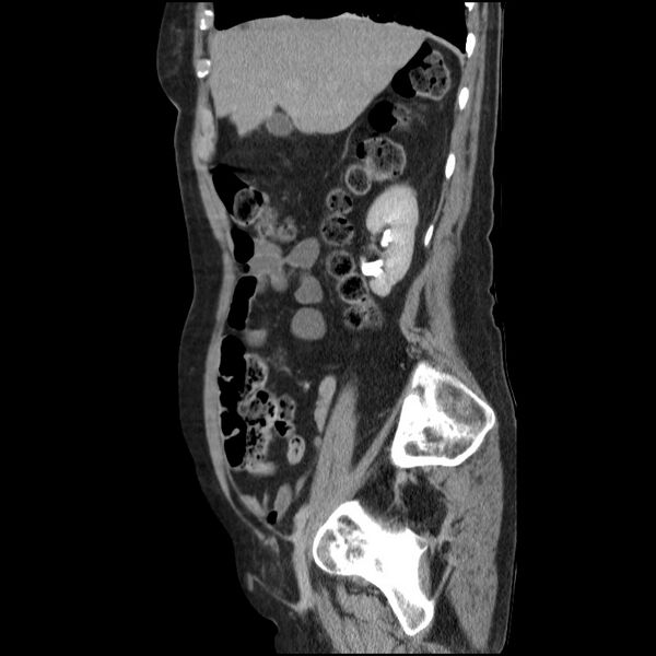 File:Bladder tumor detected on trauma CT (Radiopaedia 51809-57609 E 54).jpg