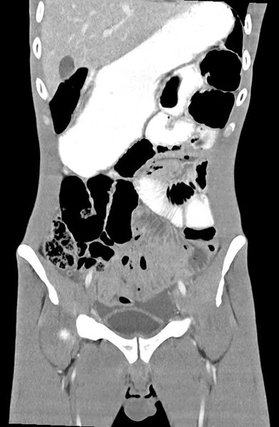 File:Blunt injury to the small bowel (Radiopaedia 74953-85987 B 33).jpg
