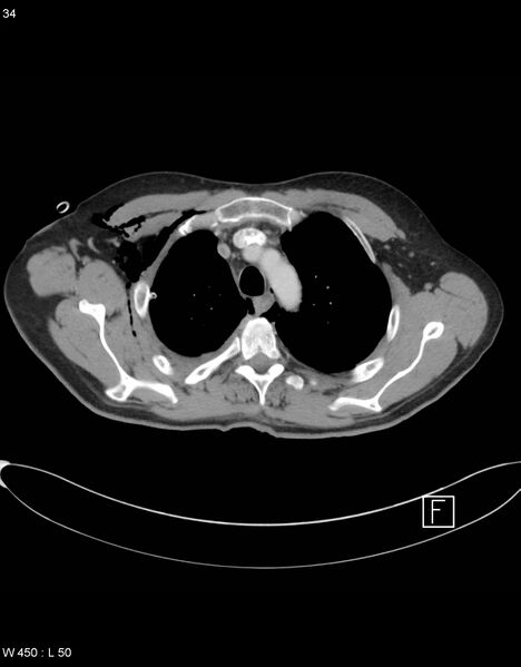 File:Boerhaave syndrome with tension pneumothorax (Radiopaedia 56794-63605 A 16).jpg