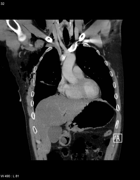 File:Boerhaave syndrome with tension pneumothorax (Radiopaedia 56794-63605 B 11).jpg