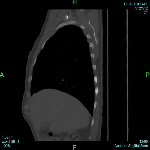 File:Bone metastases from lung carcinoma (Radiopaedia 54703-60937 Sagittal bone window 18).jpg