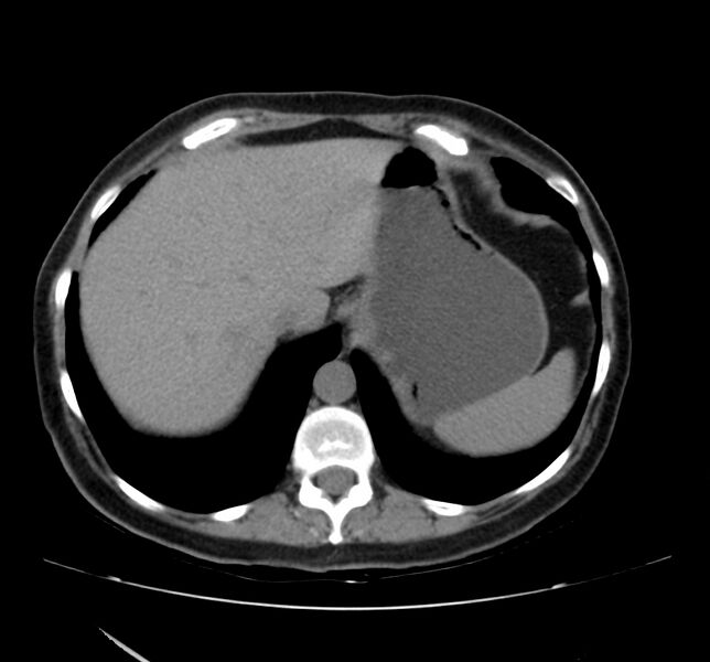 File:Bosniak renal cyst - type IV (Radiopaedia 22929-22953 Axial non-contrast 7).jpg