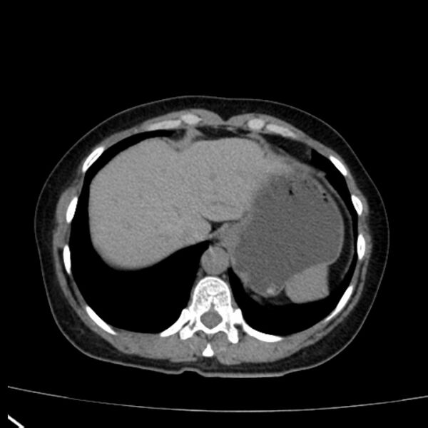 File:Bosniak renal cyst - type I (Radiopaedia 27479-27675 Axial non-contrast 12).jpg