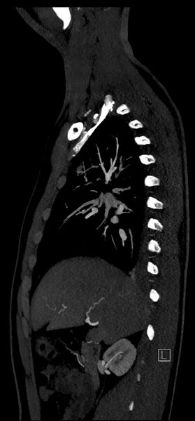 File:Brachiocephalic trunk pseudoaneurysm (Radiopaedia 70978-81191 C 34).jpg