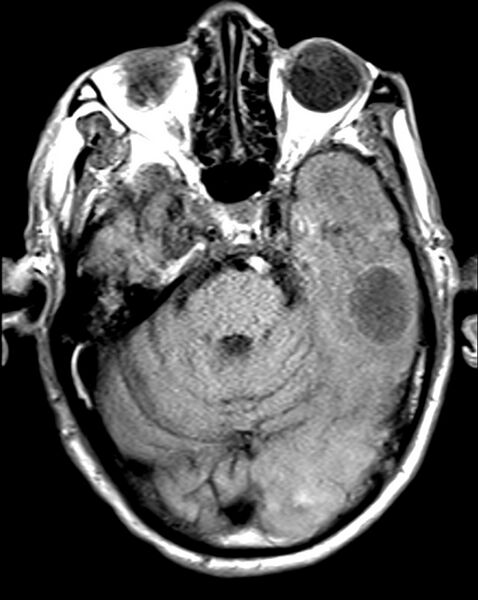 File:Brain abscess with dual rim sign (Radiopaedia 87566-103938 Axial T1 6).jpg