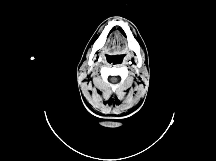 Brain injury by firearm projectile (Radiopaedia 82068-96088 A 43).jpg