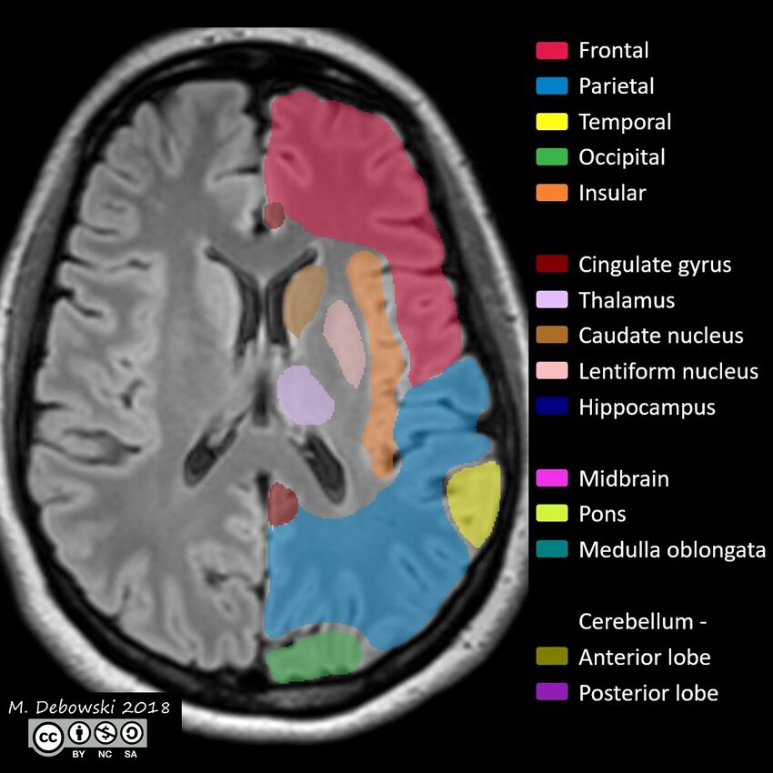 Brain lobes - annotated MRI (Radiopaedia 61691-69700 Axial 31).JPG