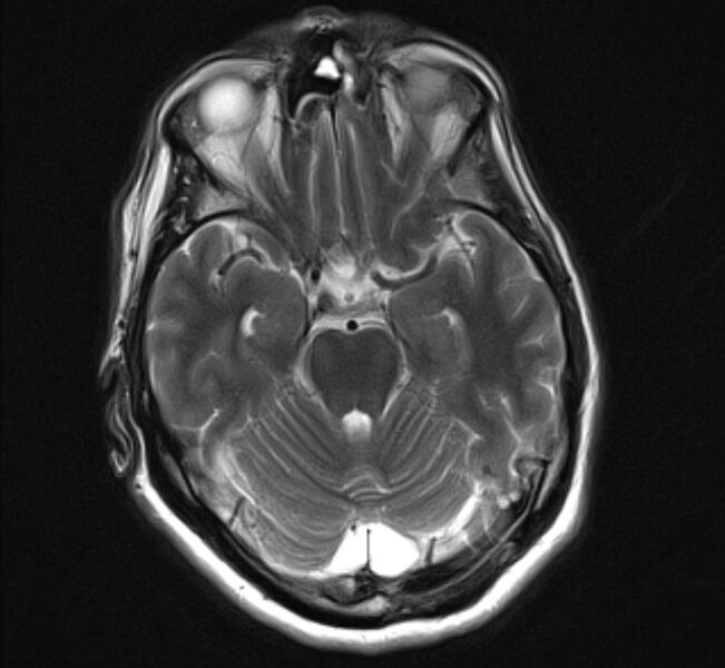 File:Brain metastases - lung cancer primary (Radiopaedia 75060-86115 Axial T2 10).jpg