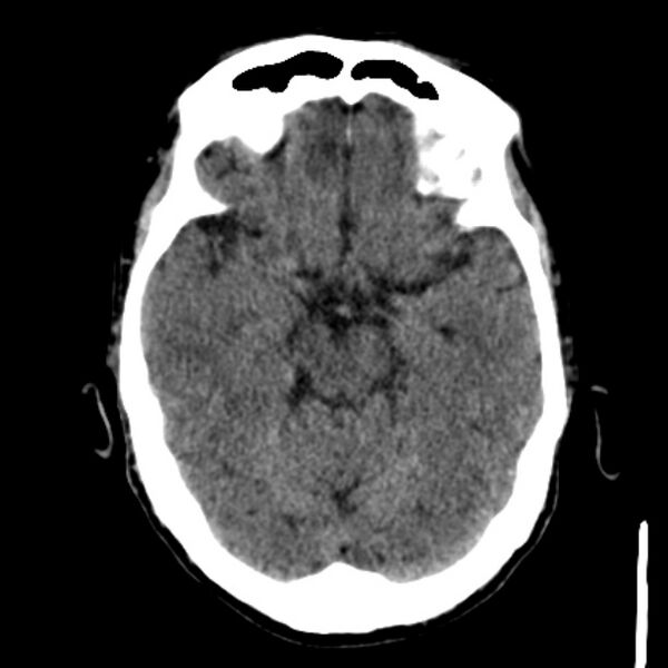 File:Brain metastases from lung cancer (Radiopaedia 27849-28092 Axial non-contrast 18).jpg