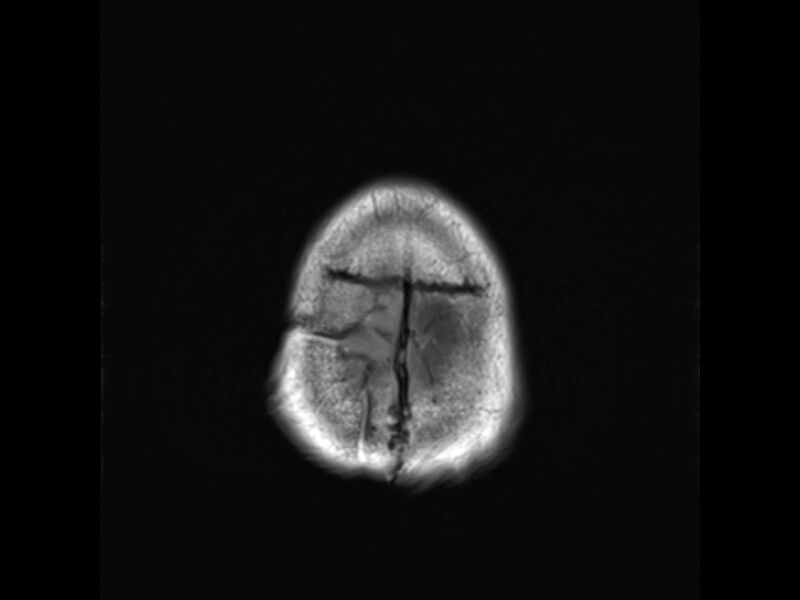 File:Brain metastases from renal cell carcinoma (Radiopaedia 42222-45297 Axial T1 24).jpg
