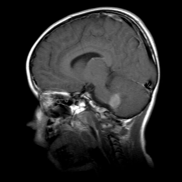 File:Brainstem ganglioglioma (Radiopaedia 10763-11224 Sagittal T1 C+ 11).jpg