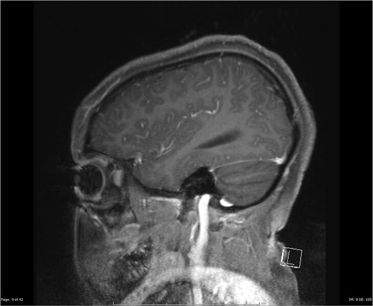 File:Brainstem glioma (Radiopaedia 21819-21775 D 9).jpg