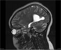 Brainstem glioma (Radiopaedia 21819-21775 Sagittal T2 6).jpg
