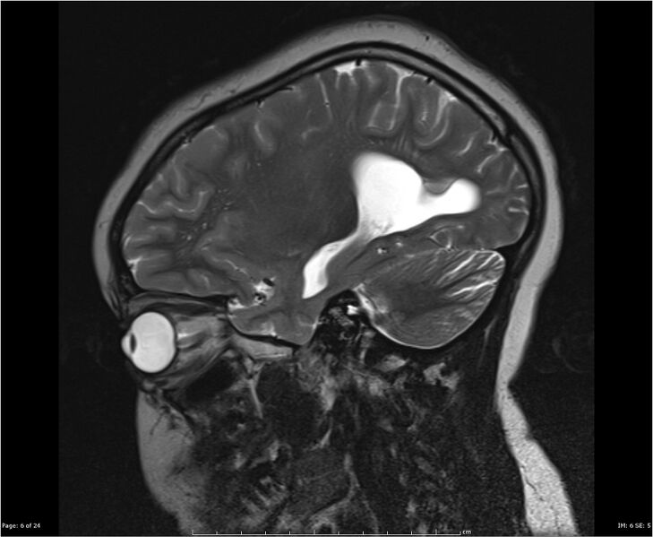 File:Brainstem glioma (Radiopaedia 21819-21775 Sagittal T2 6).jpg