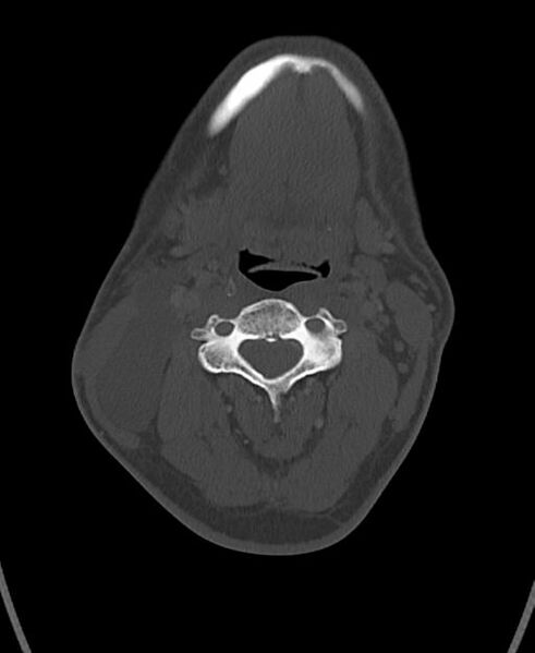 File:Branchial cleft cyst (Radiopaedia 31167-31875 Axial bone window 33).jpg
