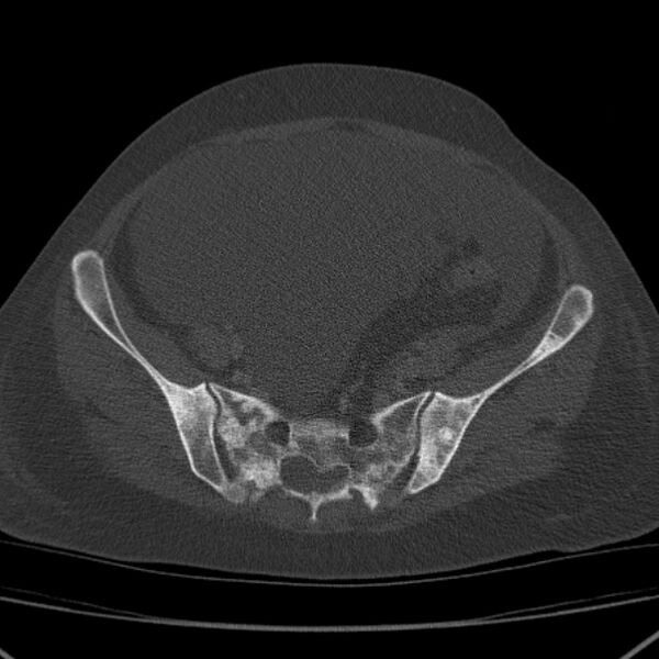 File:Breast cancer metastases - hepatic and skeletal (Radiopaedia 34201-35461 Axial bone window 87).jpg