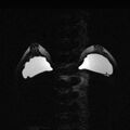 Breast implants - MRI (Radiopaedia 26864-27035 D 27).jpg