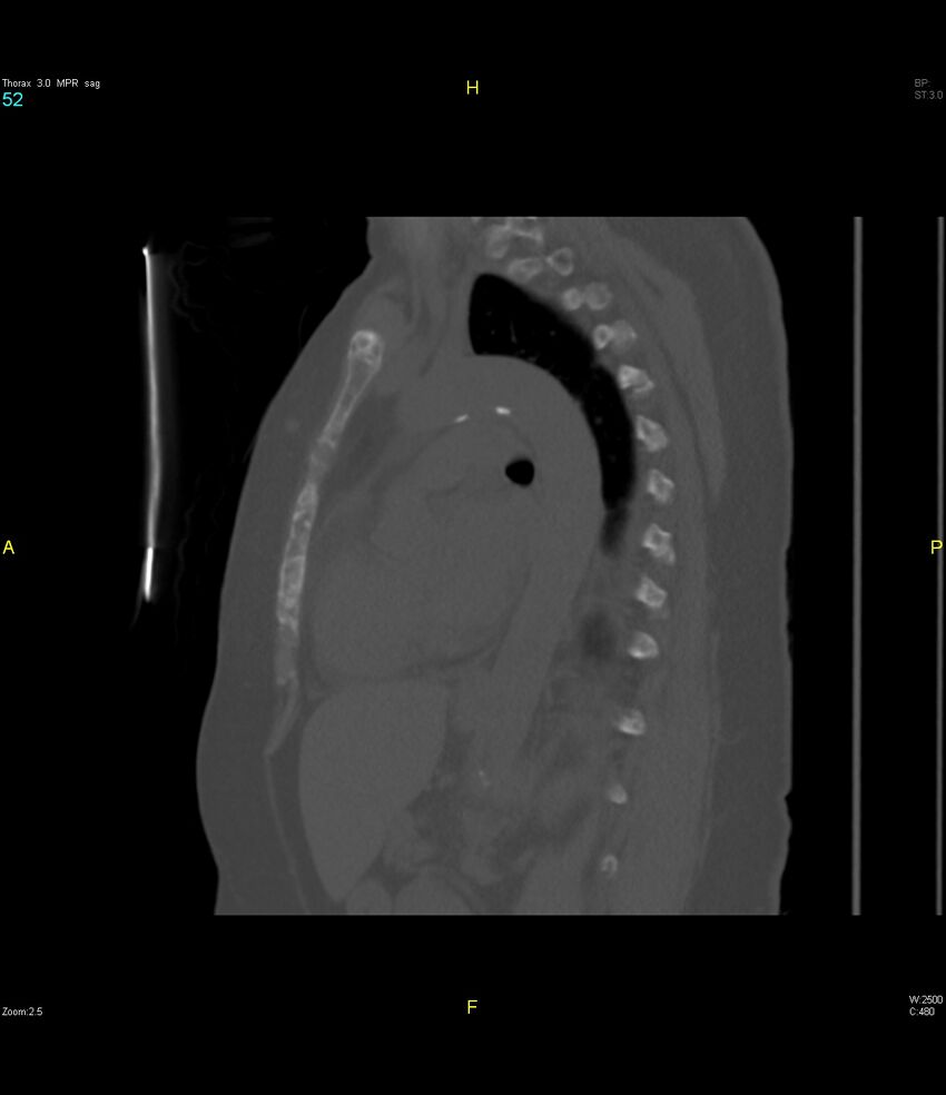 Breast primary with lung and bone metastases (Radiopaedia 40620-43228 Sagittal bone window 52).jpg