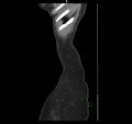 Broad ligament hernia (Radiopaedia 63260-71832 C 1).jpg