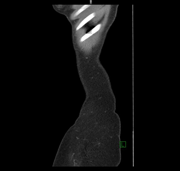 File:Broad ligament hernia (Radiopaedia 63260-71832 C 1).jpg