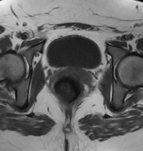 File:Broad ligament leiomyoma (Radiopaedia 81634-95516 Axial T1 21).jpg