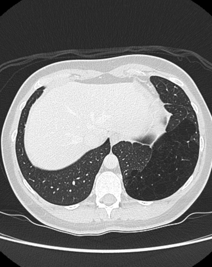 Bronchial atresia (Radiopaedia 50007-55297 Axial lung window 94).jpg