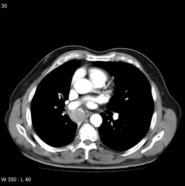 File:Bronchial carcinoid tumor with right lower lobe collapse (Radiopaedia 29060-29422 A 29).jpg