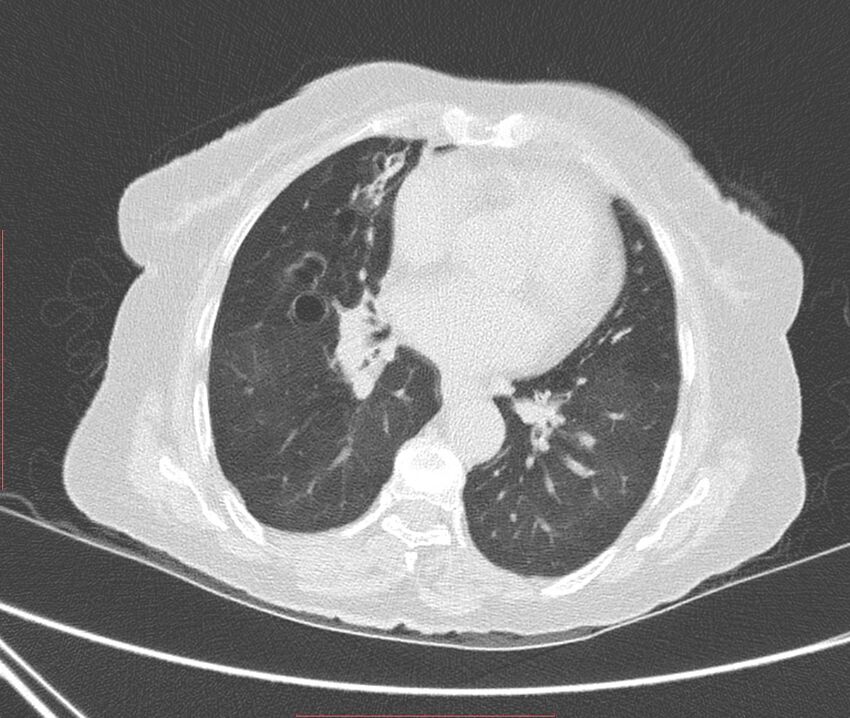 Bronchiectasis (Radiopaedia 72693-83293 Axial lung window 78).jpg
