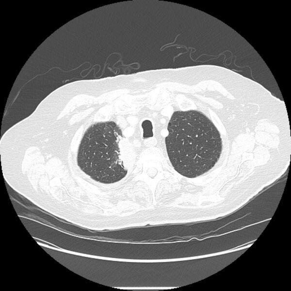 File:Bronchogenic adenocarcinoma and pulmonary embolism (Radiopaedia 9097-9806 Axial lung window 4).jpg