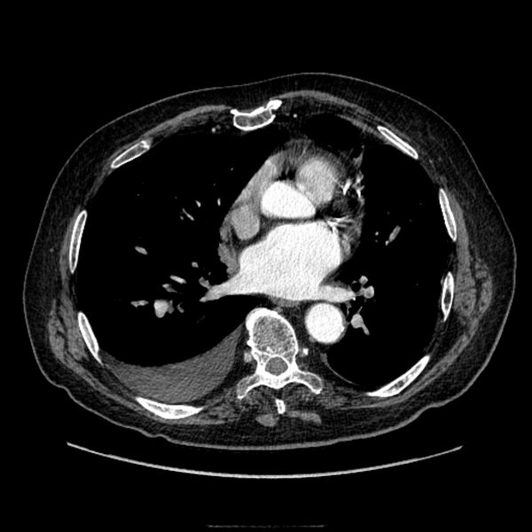 File:Bronchogenic adenocarcinoma and pulmonary embolism (Radiopaedia 9097-9806 D 37).jpg