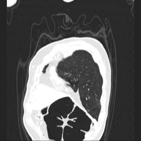 File:Bronchopleural fistula - postoperative complication (Radiopaedia 21020-20947 Coronal lung window 4).jpg