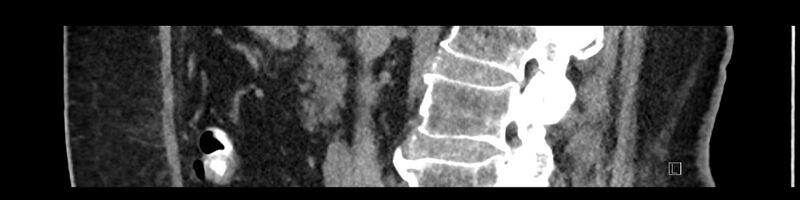 File:Buried bumper syndrome - gastrostomy tube (Radiopaedia 63843-72575 Sagittal Inject 68).jpg