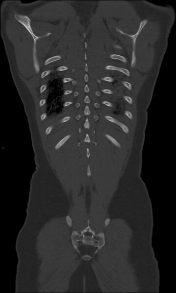 File:Burst fracture (Radiopaedia 83168-97542 Coronal bone window 63).jpg