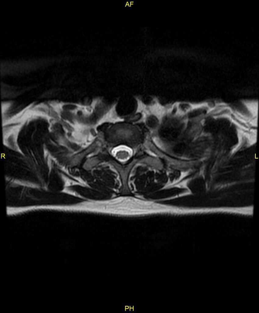 C5 nerve sheath tumor (Radiopaedia 85777-101596 Axial T2 86).jpg