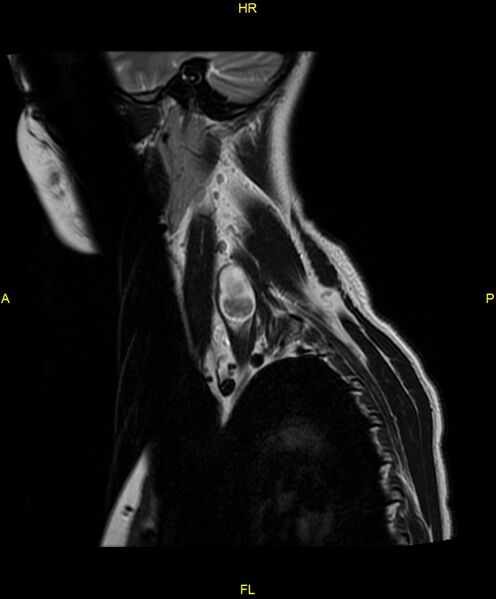 File:C5 nerve sheath tumor (Radiopaedia 85777-101596 Sagittal T2 19).jpg