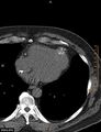Calcified cardiac fibroma (Radiopaedia 39267-41519 Axial non-contrast 9).jpg