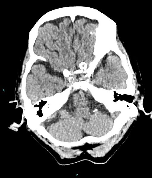 File:Calcified cerebral emboli from left ventricular thrombus (Radiopaedia 84420-99758 Axial non-contrast 72).jpg