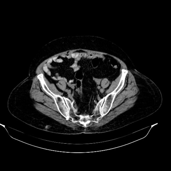 File:Calcified hydatid cyst (Radiopaedia 62000-70085 Axial non-contrast 87).jpg