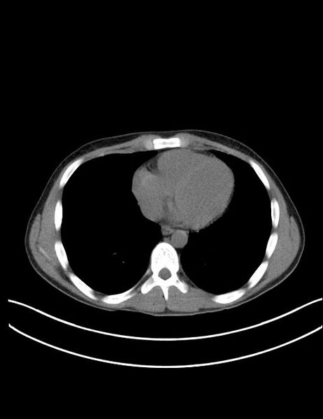 File:Calcifying pulmonary metastases (Radiopaedia 33359-34396 Axial non-contrast 21).jpg