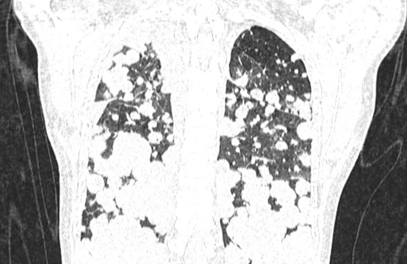 File:Cannonball metastases from breast cancer (Radiopaedia 91024-108569 Coronal lung window 115).jpg