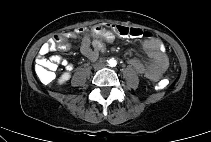 Carcinoid mesenteric tumor complicated by chylous ascites (Radiopaedia 76312-88926 A 42).jpg
