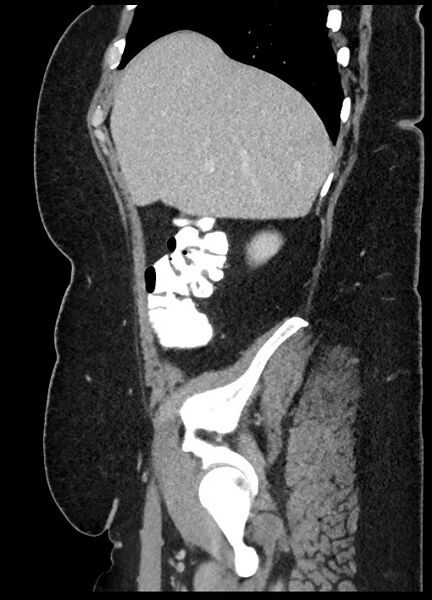 File:Carcinoid tumor - terminal ileum (Radiopaedia 60931-68739 C 83).jpg