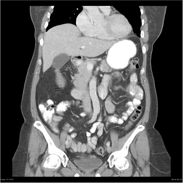 File:Carcinoid tumor of the ileum with metastasis to orbit (Radiopaedia 28165-28425 B 11).jpg