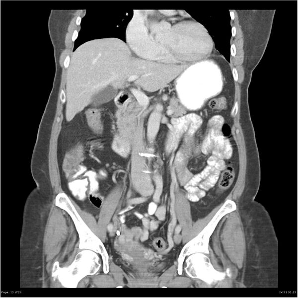 File:Carcinoid tumor of the ileum with metastasis to orbit (Radiopaedia 28165-28425 B 13).jpg