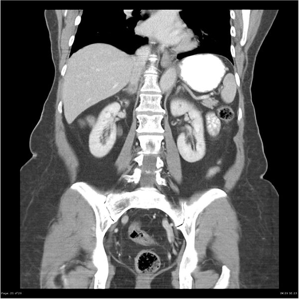 File:Carcinoid tumor of the ileum with metastasis to orbit (Radiopaedia 28165-28425 B 21).jpg