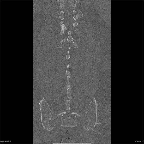 File:Cardiac trauma (Radiopaedia 32874-33858 Coronal bone window 86).jpg