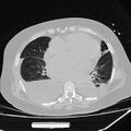 Cardiogenic pulmonary edema (Radiopaedia 29213-29609 Axial lung window 61).jpg