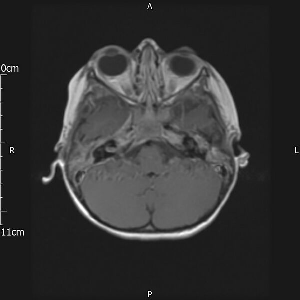File:Cavernous sinus thrombosis (Radiopaedia 79414-92512 Axial T1 C+ 7).jpg